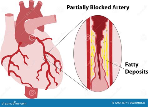 Coronary Artery Bypass Grafting Diagonal Artery Anastomosis Stock Image ...