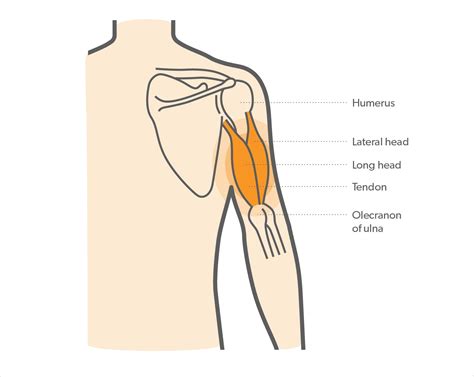 What is Triceps Tendonitis & How to Manage Elbow Pain? - Upswing Health