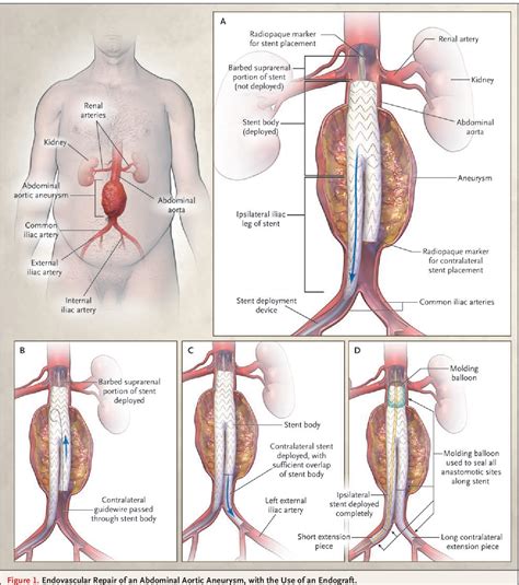 Figure 2 from Endovascular repair of abdominal aortic aneurysm ...