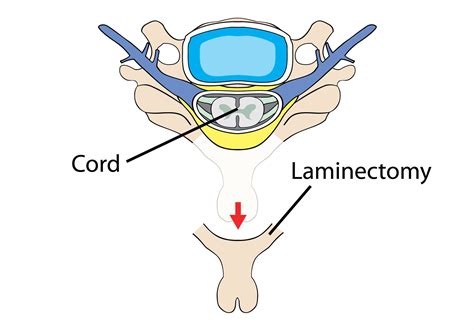 Laminectomy – Cedar Park, TX – Austin, TX - Spinal Decompression