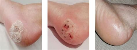 Blood Blister on Foot | Beaver Valley Foot Clinic