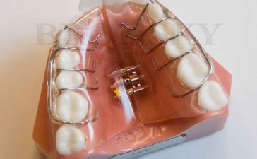 Removable Palatal Expansion Appliance - Bronsky Orthodontics