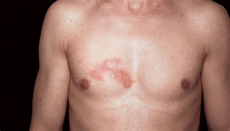 The Pictures shingles rash | Shingles Expert