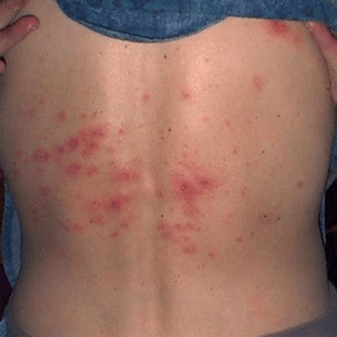 Herbal Treatment for Skin Disease- Scabies - Theayurveda