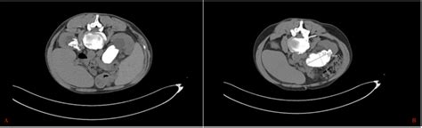 Axial view CT scan taken upon initial presentation | Download ...