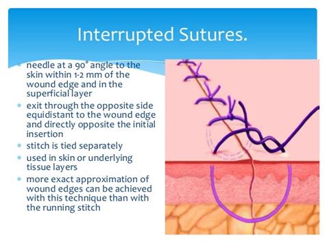 Wound management