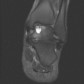 Treatment of Ankle Osteochondral Lesions | Musculoskeletal Key