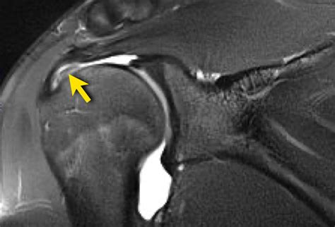 Supraspinatus Tear Mri