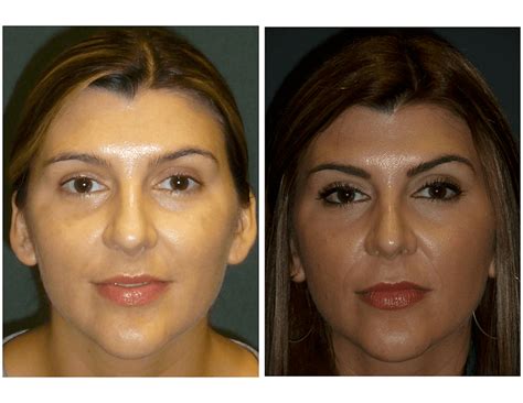 Before & After Gallery - Houston, TX: Houston Sinus Surgery