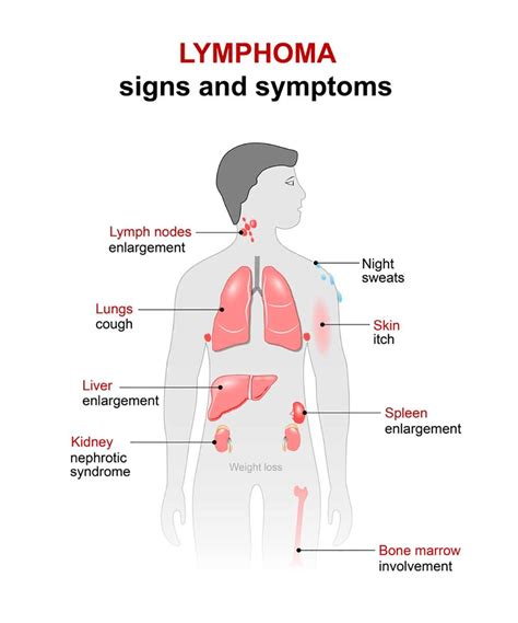 Lymphoma Symptoms - 9 Signs of Hodgkin's & Non-Hodgkin's lymphoma!