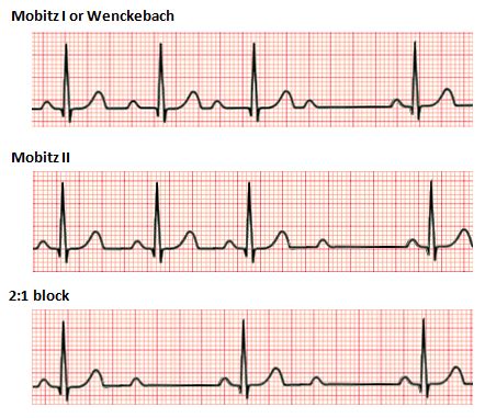 2nd Degree AV blocks | Time of Care