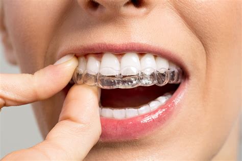 Invisible Braces - clear braces from invisalign to straighten teeth