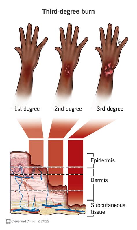 3rd-Degree Burn: What It Is, Treatment & Healing