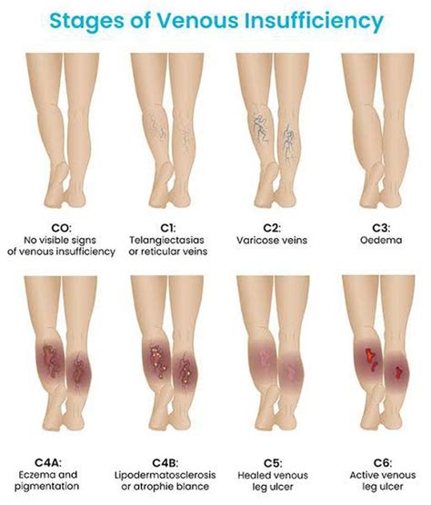 Stages of Venous Insufficiency - MEDizzy