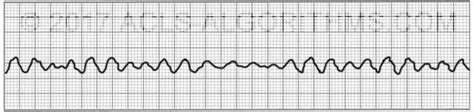 Ventricular fibrillation | ACLS-Algorithms.com