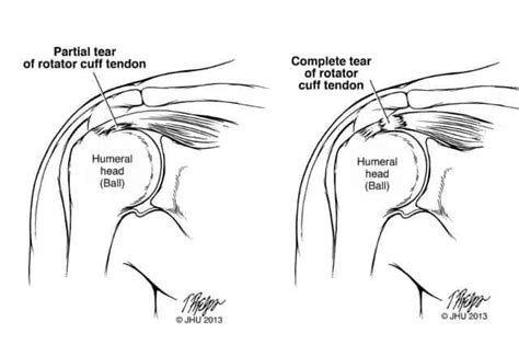 The Complete Guide to a Rotator Cuff Tear | Kinetic Labs