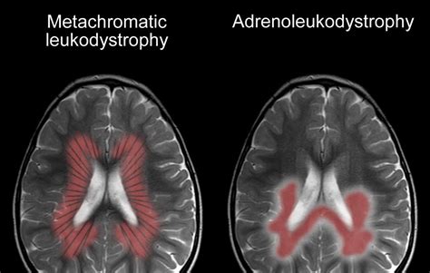 Roentgen Ray Reader: Dysmyelinating Disorders (Leukodystrophies)