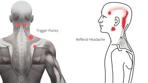 How to Cure Cervicogenic Headache at Home? Follow These 4 Easy Exercises