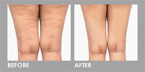 Mesolipo Fat Melting Slimming Injections | Premier Clinic