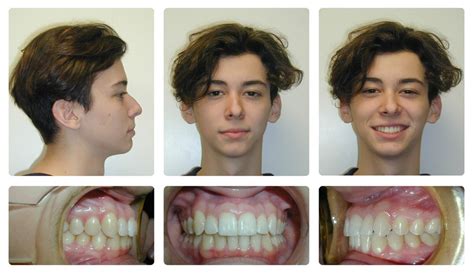 Overbite Before And After Profile