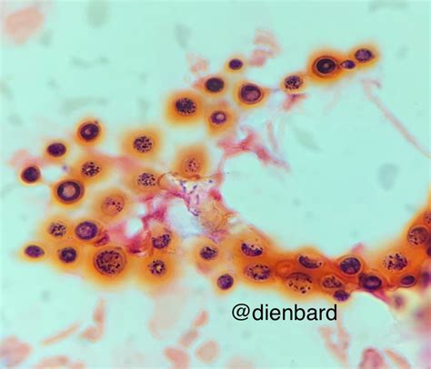 Cryptococcus Neoformans Gram Stain