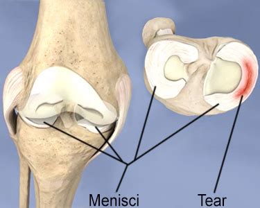 Torn Meniscus: Symptoms and Nonsurgical Treatment | HSS