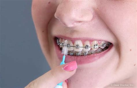 Brushing & Flossing with Braces | Sun Orthodontics | San Diego California