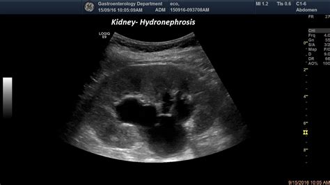 Hydronephrosis Grading Ultrasound