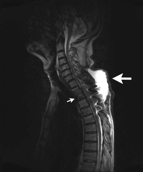 MRI of the thoracic spine (T2-weighted, sagittal reconstruction). The ...