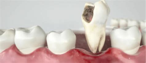 Tooth Extraction Services | Pearland, TX Dentist