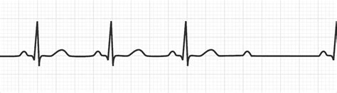 Piñón mal humor Uluru atrioventricular av block femenino vapor Tremendo