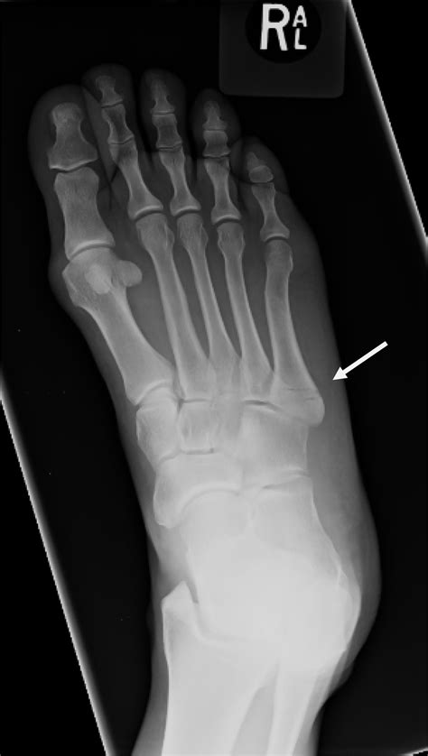 Metatarsal Stress Fracture Treatment Options