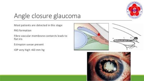 neovascular glaucoma