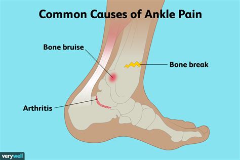 Ankle Pain Causes and Treatments