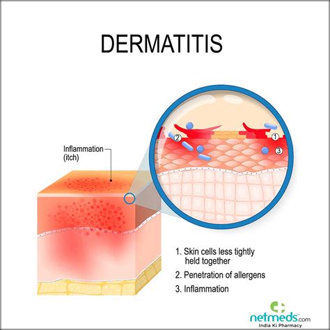 Contact Dermatitis: Causes, Symptoms and Treatment | Netmeds