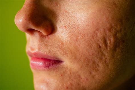 3D imaging technique measures severity of atrophic acne scars