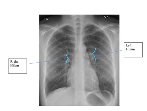 Hilum of the Lung | Geeky Medics