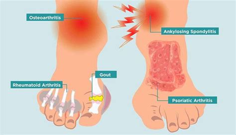 10 Main Causes of Foot Pain – New Life Ticket