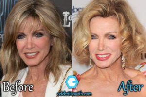 Donna Mills Plastic Surgery, Facelift, Necklift, Before and After ...