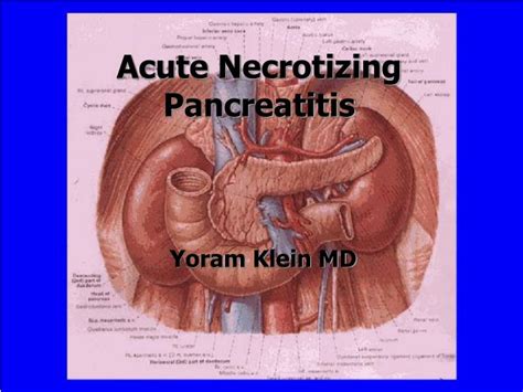 PPT - Acute Necrotizing Pancreatitis PowerPoint Presentation, free ...