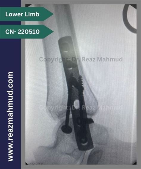 Bimalleolar Ankle Fracture | ORIF [CN-220510] - Dr. Reaz Mahmud