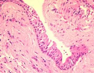 Calcifying Odontogenic Cyst Histology