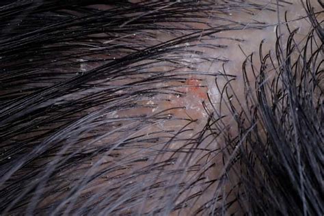 Scabs and Sores on Scalp: 17 Causes, Pictures and Treatment