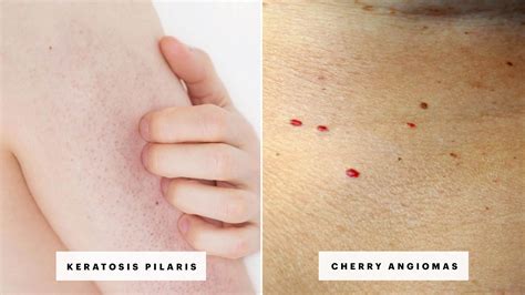 Small Red Dots On Skin After Workout - WorkoutWalls