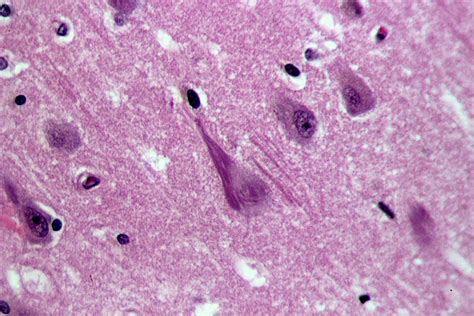 Neurofibrillary Tangles