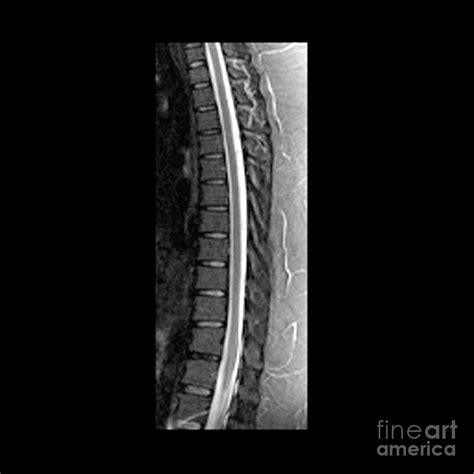 Sagittal Mri Of Normal Thoracic Spine Photograph by Medical Body Scans ...