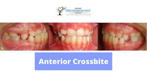 What Is A Crossbite? Signs, Effects, and Treatment - Miami Orthodontist ...