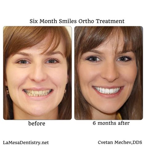 Six Month Smiles Braces offered in La Mesa Dental Center | Braces ...