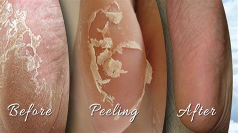 Home Remedies For Peeling Skin On Your Feet - TOP 5 DIY