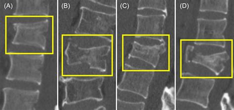 Pathological Fracture Spine